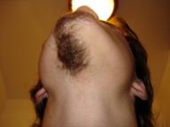 Angeh�ngtes Bild: Haarwuchsst_rung.jpg